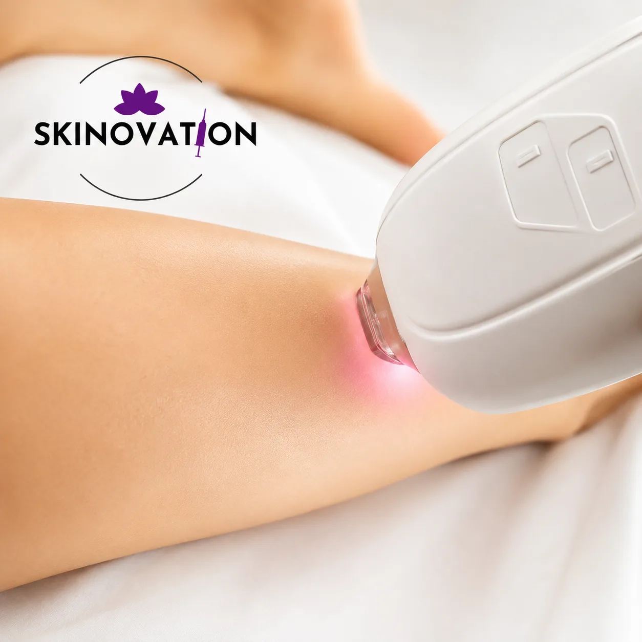 Laser hair removal treatment using a handheld laser device on the skin at Skinovation Aesthetics