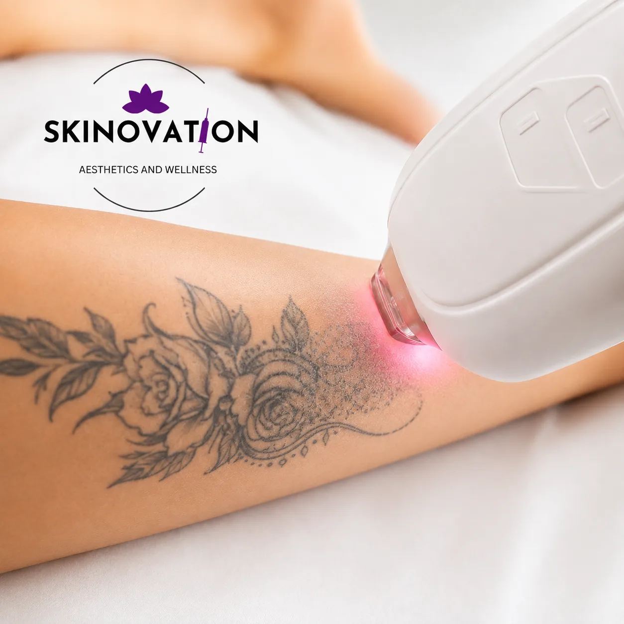 Laser tattoo removal treatment using a handheld laser device on the skin at Skinovation Aesthetics
