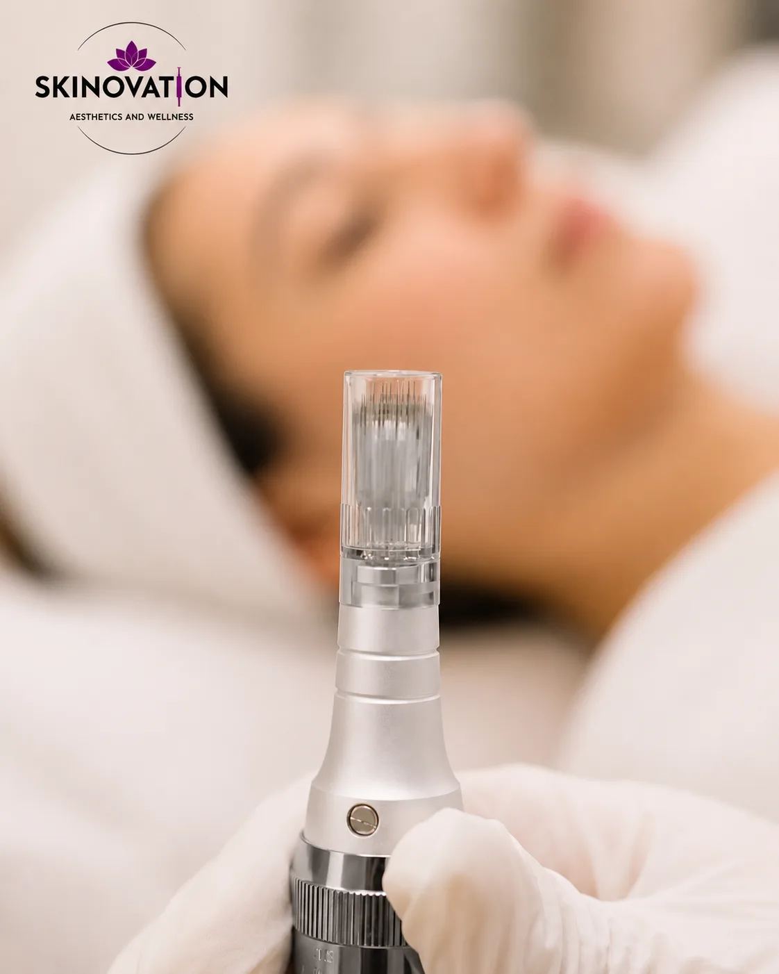 Professional PRP therapy and microneedling treatment equipment at Skinovation Aesthetics, Katy, TX